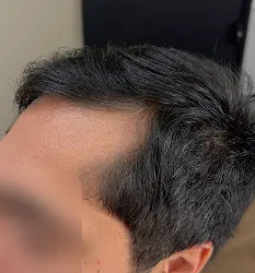 Densidade capilar depois